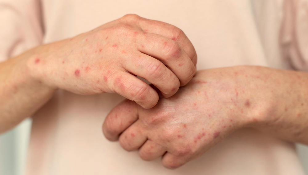 impetigonarokah.jpg